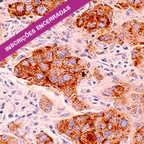 Imagem microscópica de células de câncer de mama